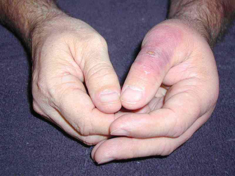corner spider bite and its damage 1