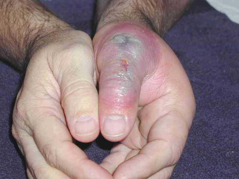 corner spider bite and its damage 1