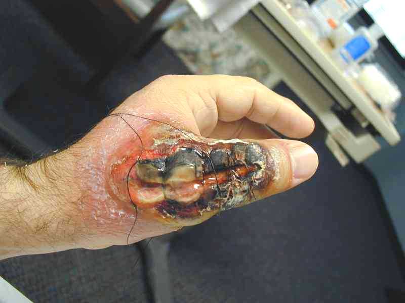 corner spider bite and its damage